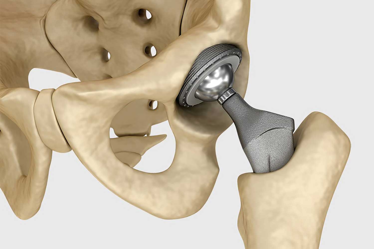 Tantalum is widely used in reconstructive surgery due to its exceptional biocompatibility, corrosion resistance, and ability to promote bone ingrowth. Tantalum orthopedic implants, such as acetabular cups, have high volumetric porosity, which allows bone tissue to grow into the implant’s structure, enhancing stability and long-term fixation